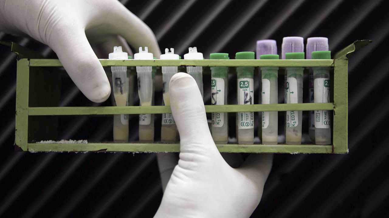 Donna guarisce dall'Hiv: primo caso al mondo